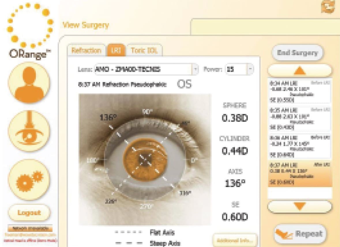 Limbal Relaxing Incision
