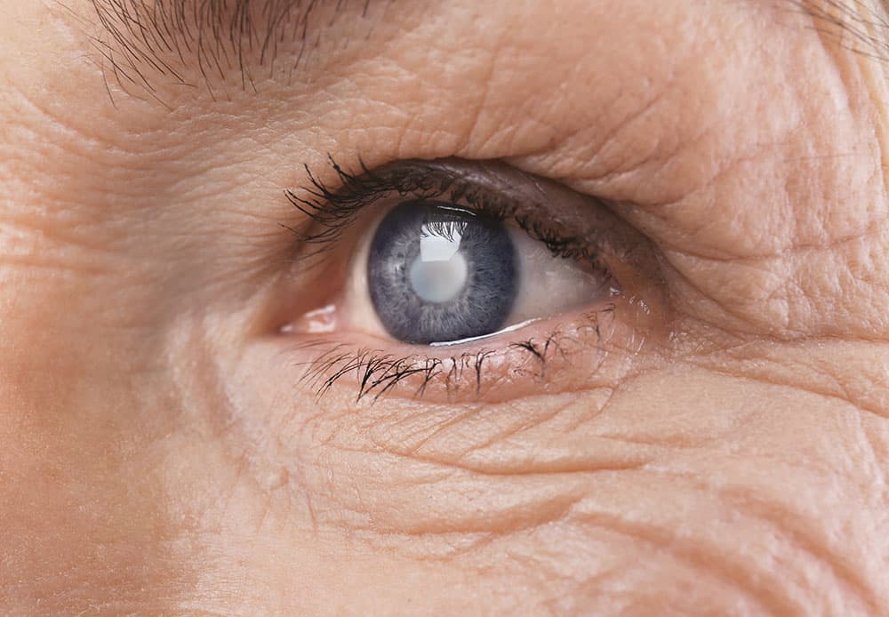 A close up of an eye with glaucoma