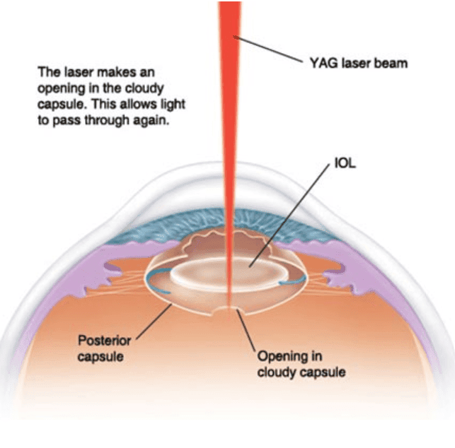 YAG laser description